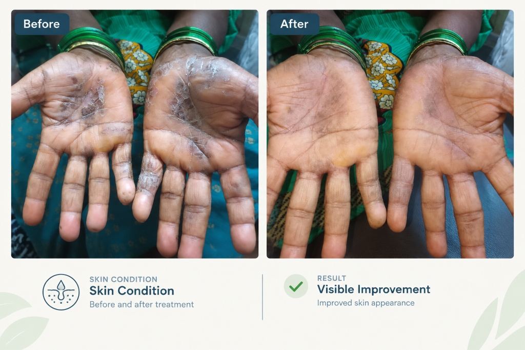 Palmar Dermatitis & Skin Peeling