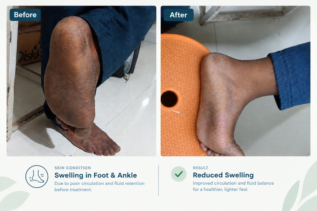 Foot & Ankle Swelling
